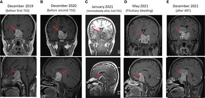 An aggressive cabergoline-resistant, temozolomide-responsive macroprolactinoma due to a germline SDHB pathogenic variant in the absence of paraganglioma or pheochromocytoma